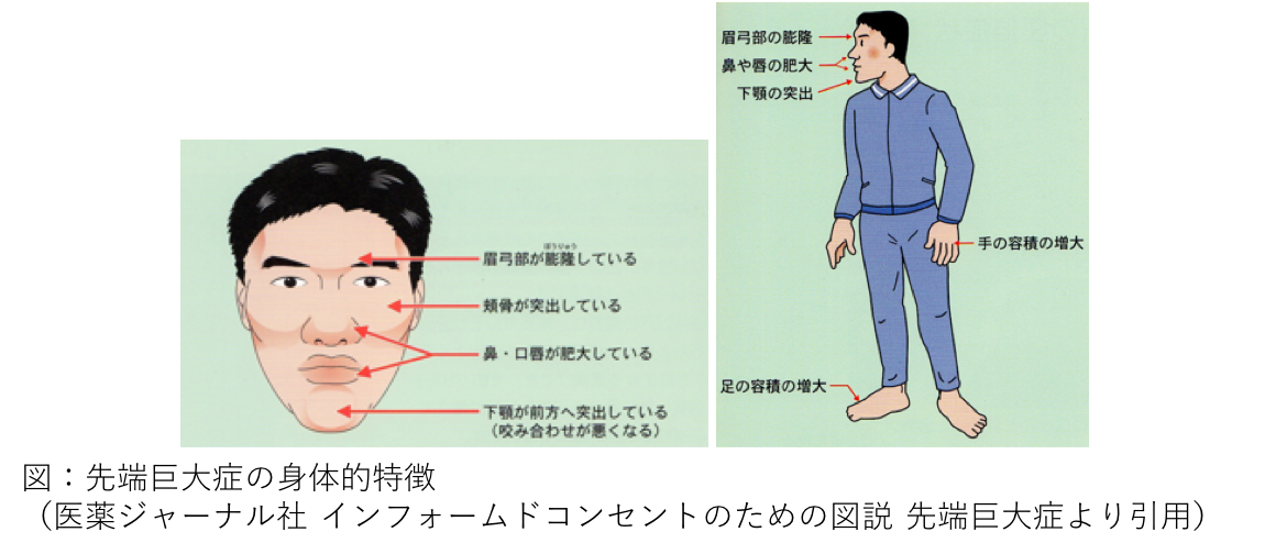 先端巨大症の身体的特徴