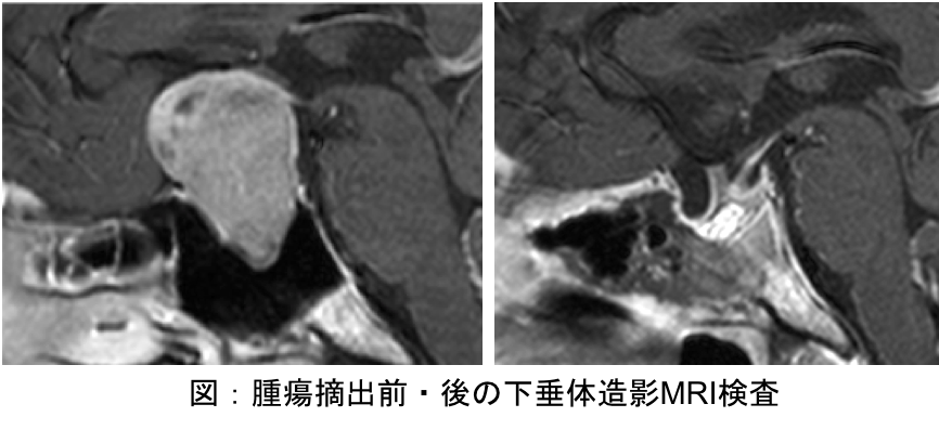 腫瘍摘出前・後の下垂体造影MRI検査