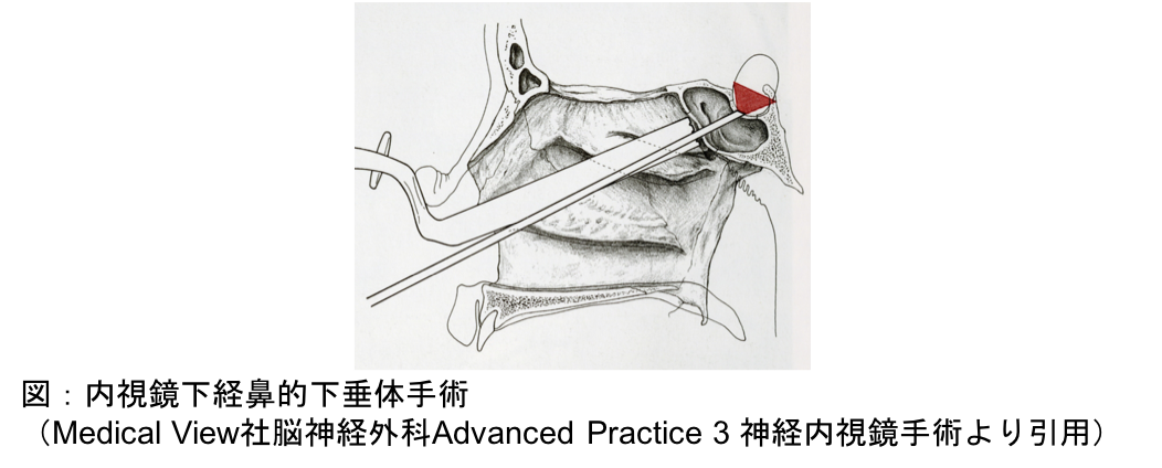 内視鏡下経鼻的下垂体手術