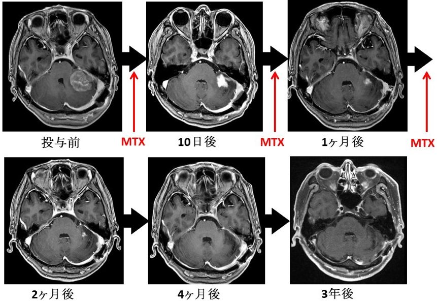 中枢神経原発悪性リンパ腫