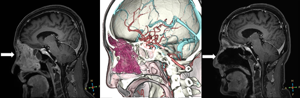 鼻・副鼻腔から頭蓋底に進展する腫瘍です。耳鼻咽喉科と合同手術を行い、開頭・経鼻手術を同時に行って摘出しました。