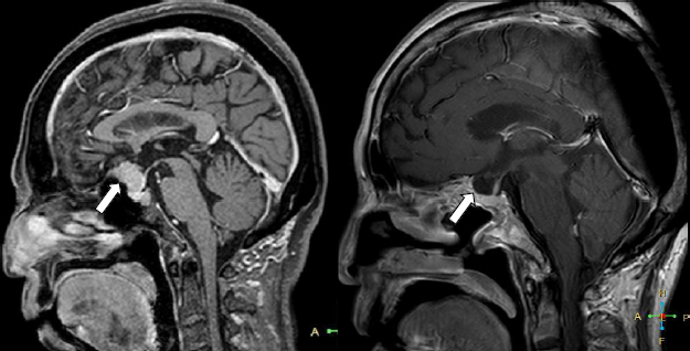 視野・視力障害で発症した鞍結節部髄膜腫です。以前は開頭手術が選択されていましたが、最近は経鼻手術を行う事が増えています。視神経に優しい視力の改善など良好な結果を得ています。