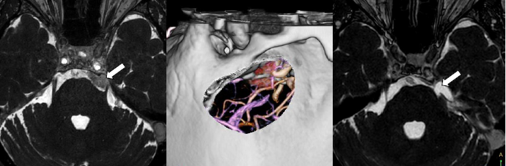 三叉神経痛で発症した錐体斜台部髄膜腫です。術前シミュレーションで骨削除範囲を決めて手術を行いました。