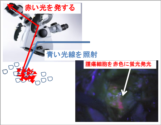 蛍光誘導手術（光線力学的診断）