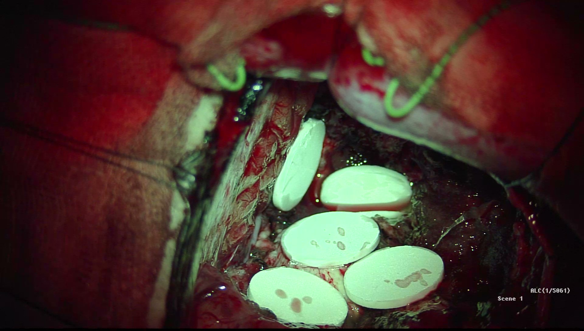 カルムスチンウェハー（留置型抗がん剤）