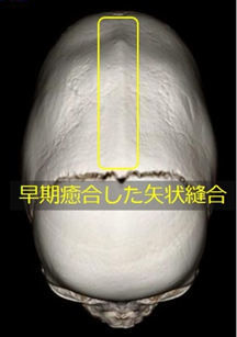 頭蓋縫合早期癒合症