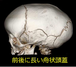 頭蓋縫合早期癒合症