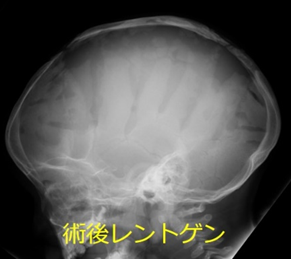 頭蓋縫合早期癒合症