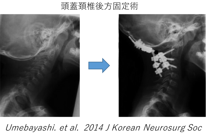 頭蓋頸椎後方固定術
