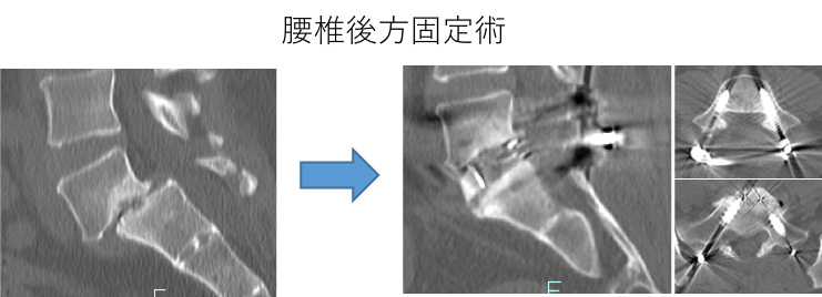 腰椎後方固定術