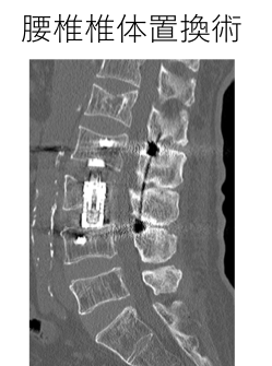 腰椎椎体置換術