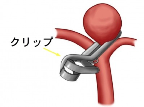 脳動脈瘤クリッピング術