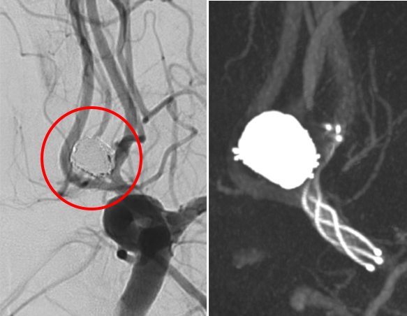 術後の造影写真です。主幹動脈は温存できており、動脈瘤は造影されなくなっています。