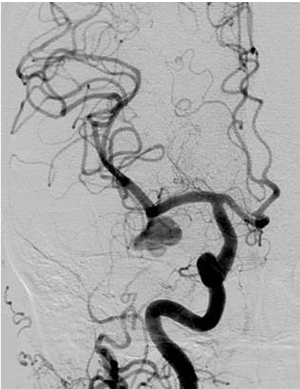 術前の造影写真です。〇内に脳動脈瘤が造影されています。