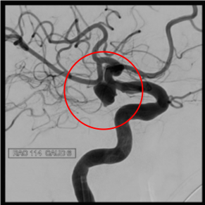 術前の造影写真です。〇内に脳動脈瘤が造影されています。