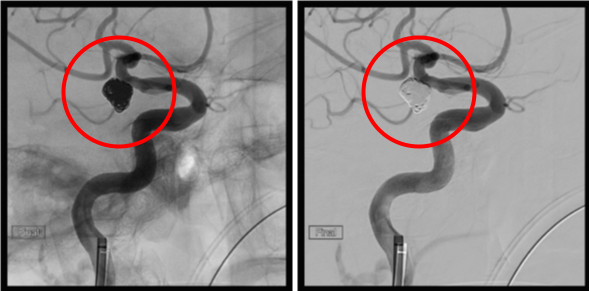 術後の造影写真です。主幹動脈は温存できており、動脈瘤は造影されなくなっています。