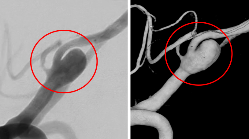 術前の造影写真です。〇内に脳動脈瘤が造影されています。