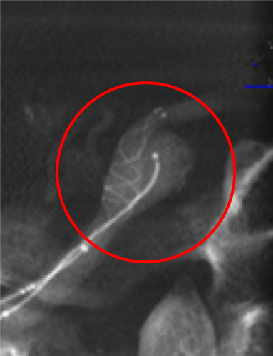 動脈瘤内にマイクロカテーテルを挿入しステントを展開しています。