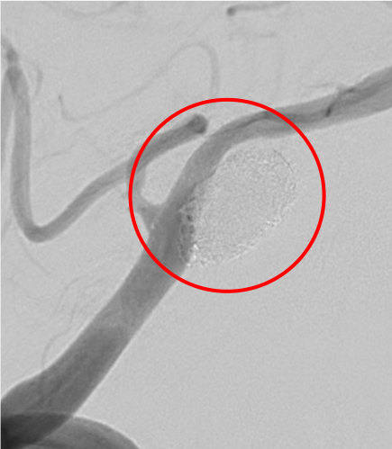 術後の造影写真です。主幹動脈は温存できており、動脈瘤は造影されなくなっています。