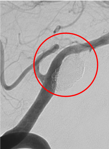 手術1年後、動脈瘤の再発はありません。