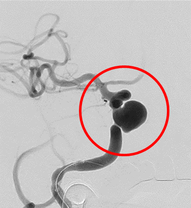術前の造影写真です。〇内に脳動脈瘤が造影されています。