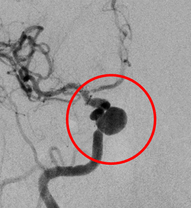 術直後の造影写真ではまだ脳動脈瘤は造影されています。