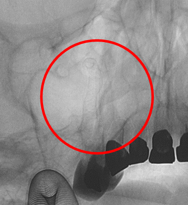術直後の写真です。〇内は留置されたフローダイバーターステントです。