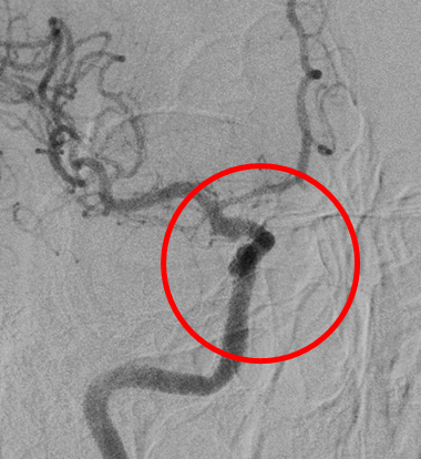 半年後の造影写真では脳動脈瘤は完全に消失しています。