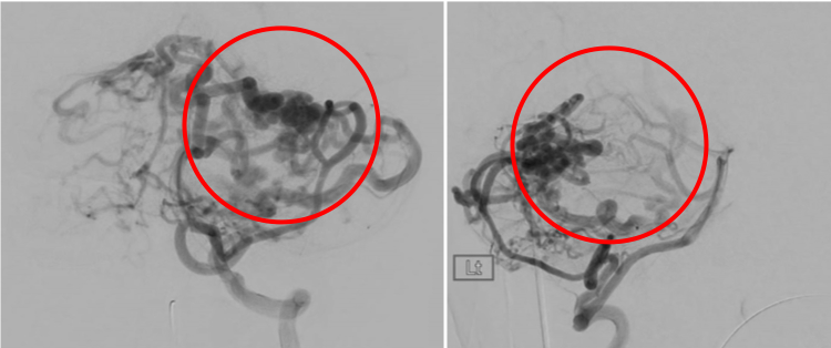 術前の造影写真です。〇内に脳動静脈奇形が描出されています。