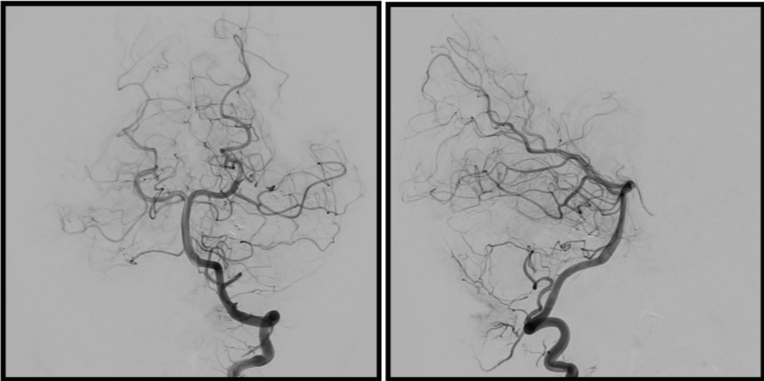 塞栓術および摘出術後の造影写真です。脳動静脈奇形は消失しております。