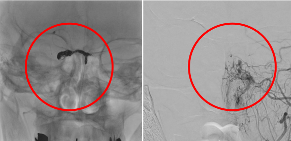 硬膜動静脈瘻を塞栓し動脈血の逆流は消失しています。