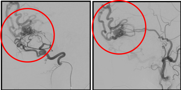 術前の造影写真です。〇内に硬膜動静脈瘻を認めます。