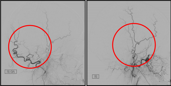 硬膜動静脈瘻を塞栓し動脈血の逆流は消失しています。