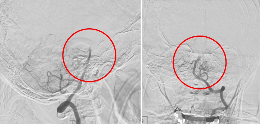 術前の造影写真です。〇内で脳底動脈に血栓が詰まり完全閉塞しています。