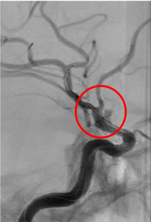 術前の造影写真です。〇内に脳動脈瘤が造影されています。