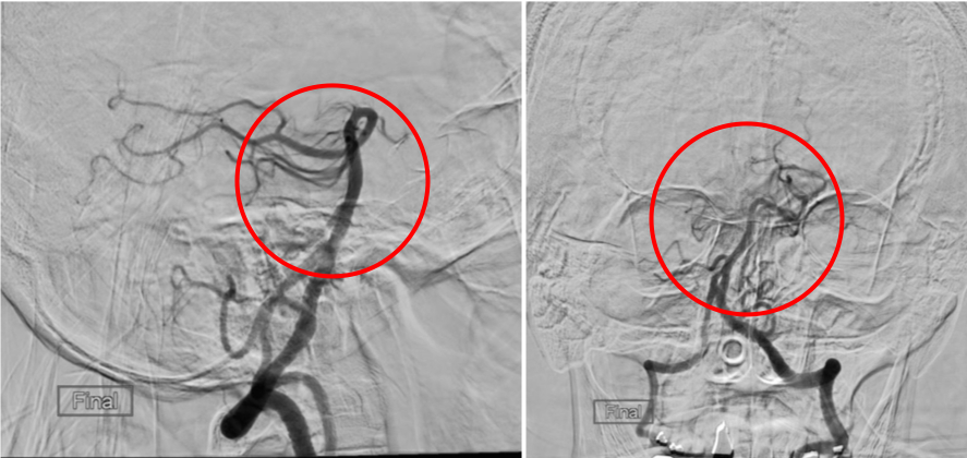 術後の造影写真です。閉塞していた脳底動脈は完全に再開通しています。