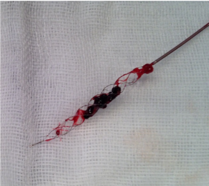 ステントで回収できた暗赤色の血栓の写真です。