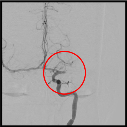 術前の造影写真です。〇内で血栓により左中大脳動脈が完全閉塞しています。