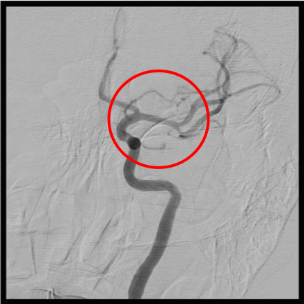 術後の造影写真です。左中大脳動脈は完全に再開通しています。