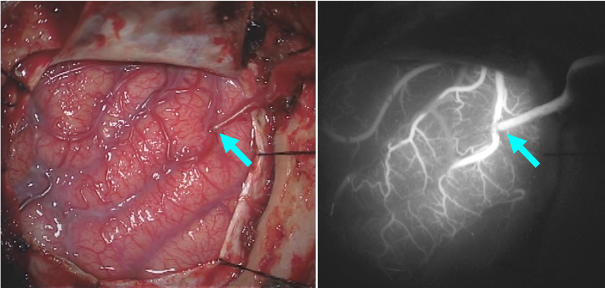 もやもや病に対する直接バイパス術の術中写真です。矢印の部位で血管吻合を行っています。