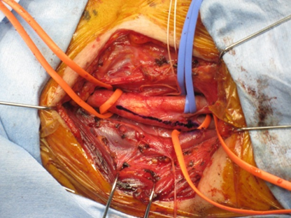 図1　頚動脈を露出させたところの術中写真です。