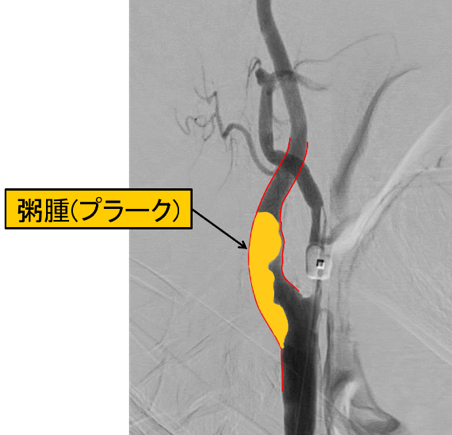 造影されていない部分にはプラークが付着しています。