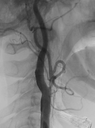 頚動脈ステント留置術後の造影写真です。狭窄は改善しています。
