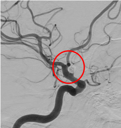 術後4週間、動脈瘤の再発はありません。
