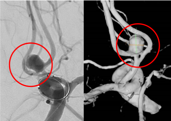 術前の造影写真です。〇内に脳動脈瘤が造影されています。