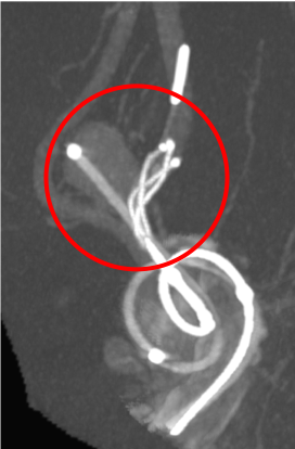 動脈瘤内にマイクロカテーテルを挿入しステントを展開しています。