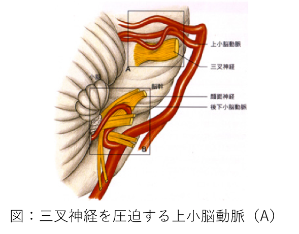 図1　三叉神経を圧迫する上小脳動脈