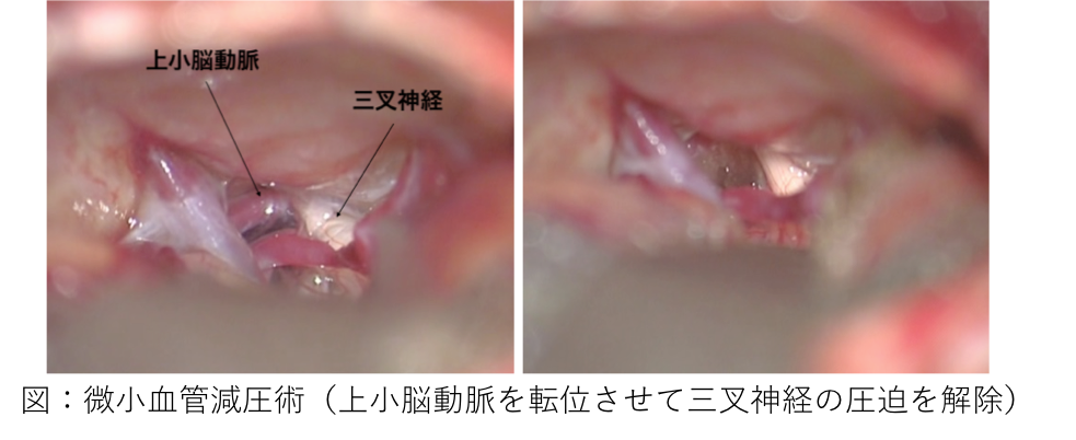 図2　微小血管減圧術