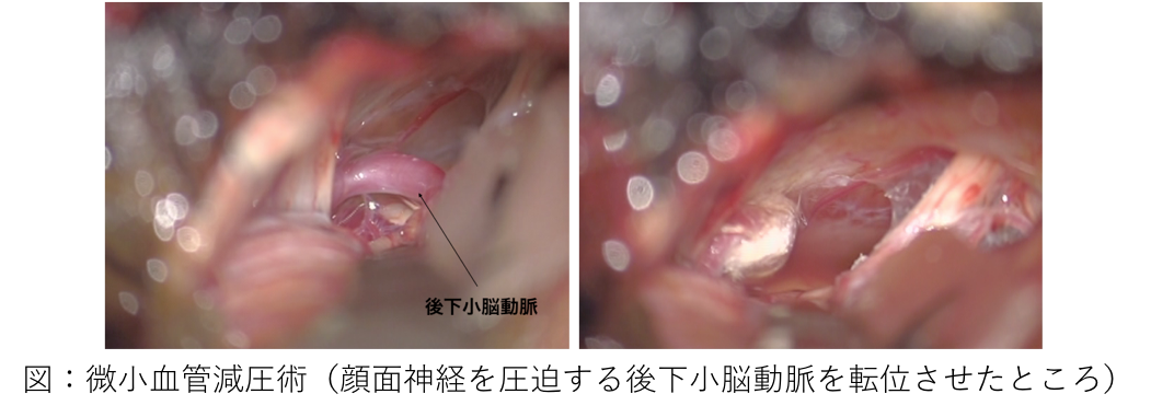 図　微小血管減圧術